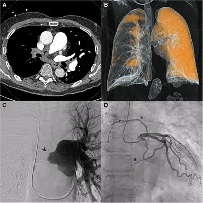 Case report: Multimodality imaging of unusual coronary to pulmonary collaterals in chronic thromboembolic pulmonary hypertension